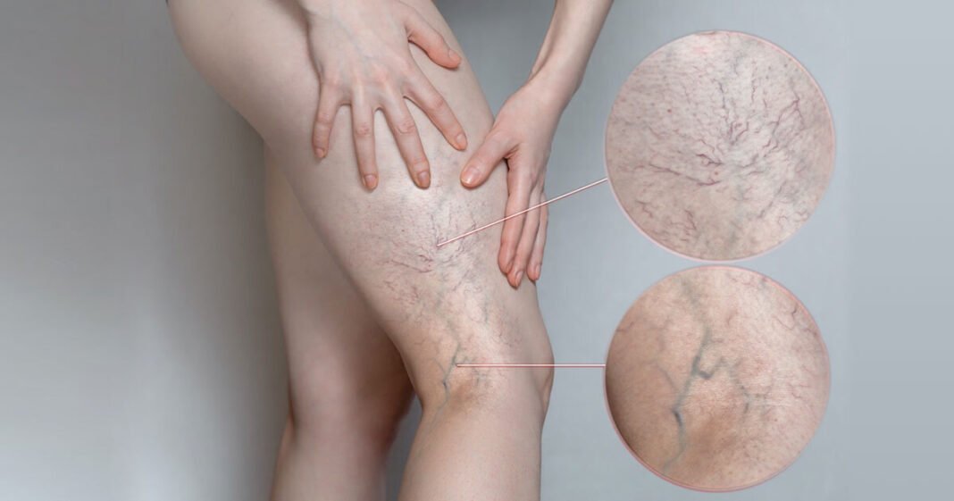 Sclerotherapy Vein Treatment