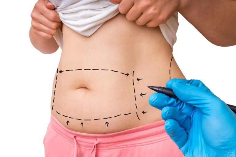 How to Choose the Right Time of Year for Tummy Tuck Surgery