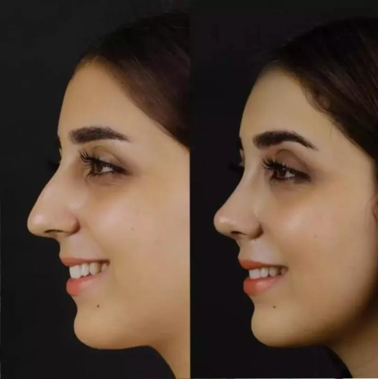 Rhinoplasty in Dubai: Male vs. Female Differences Explained