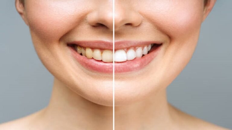 Illuminate Your Smile: The Ultimate Guide to Laser Teeth Whitening in Islamabad