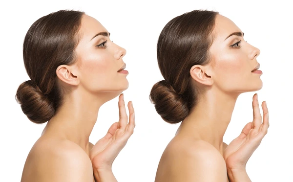 chin reduction surgery san diego